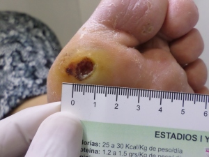 Úlcera en pie de un paciente diabético
